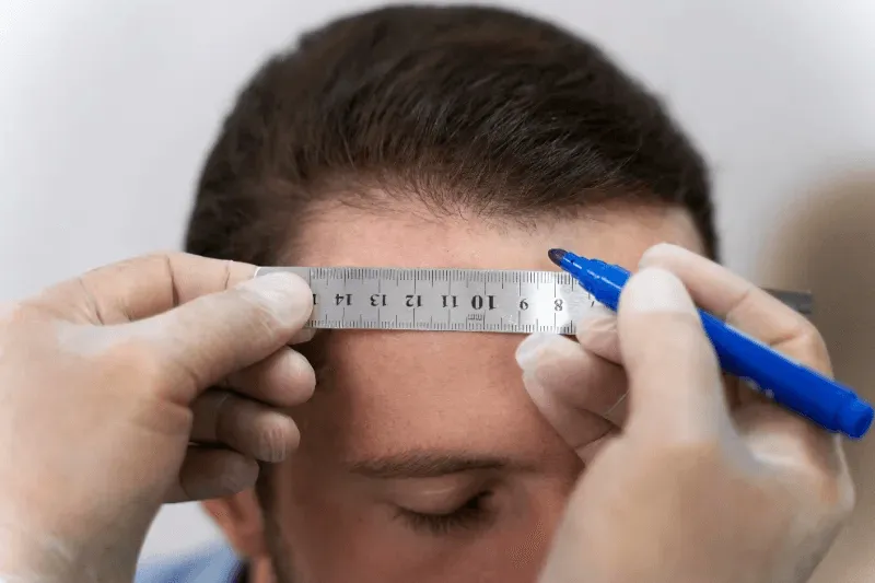 The image shows a person undergoing a hairline measurement, likely part of a treatment or consultation for hair growth.