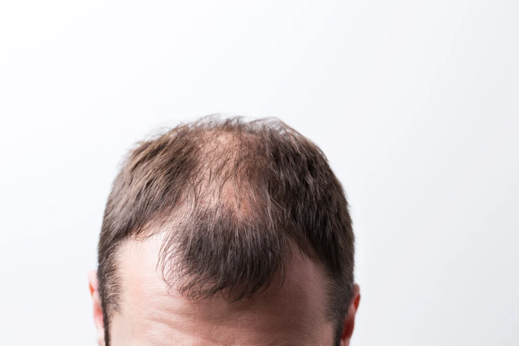 Causes of Hair Loss Lesser-Known Facets and Challenges