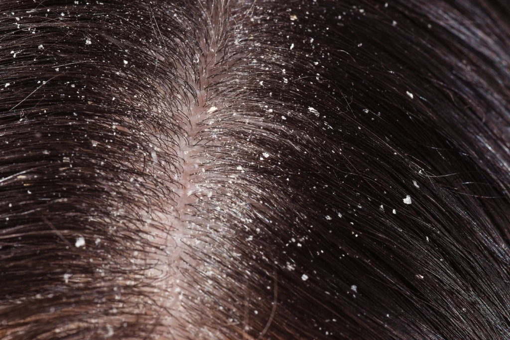 Understanding Dandruff Causes and Effects